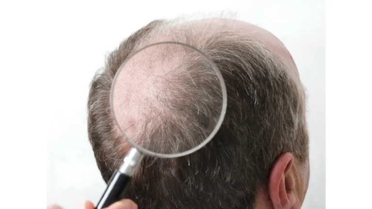 How Long Does a Hair Transplant Last?