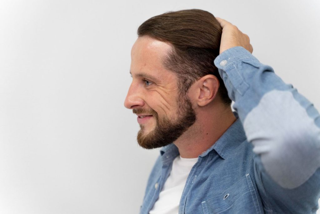 A man with a beard and blue shirt touching his hair, showcasing a men's hair replacement system in Stafford.